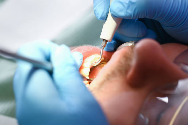 Best Emergency Dentist for Lost Fillings or Crowns in New Market, TN